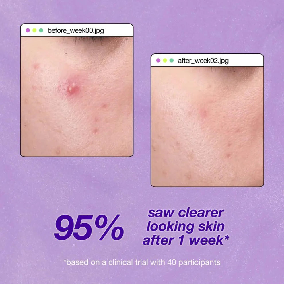 ClearStart Breakout Clearing Liquid Peel 30ml
